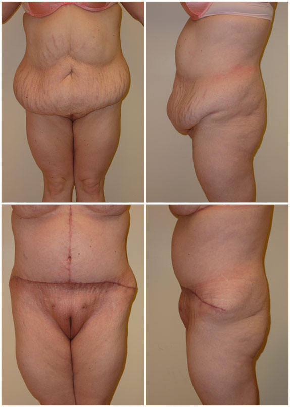 Before & After Panniculectomy Photos on Age 40 Patient in NH