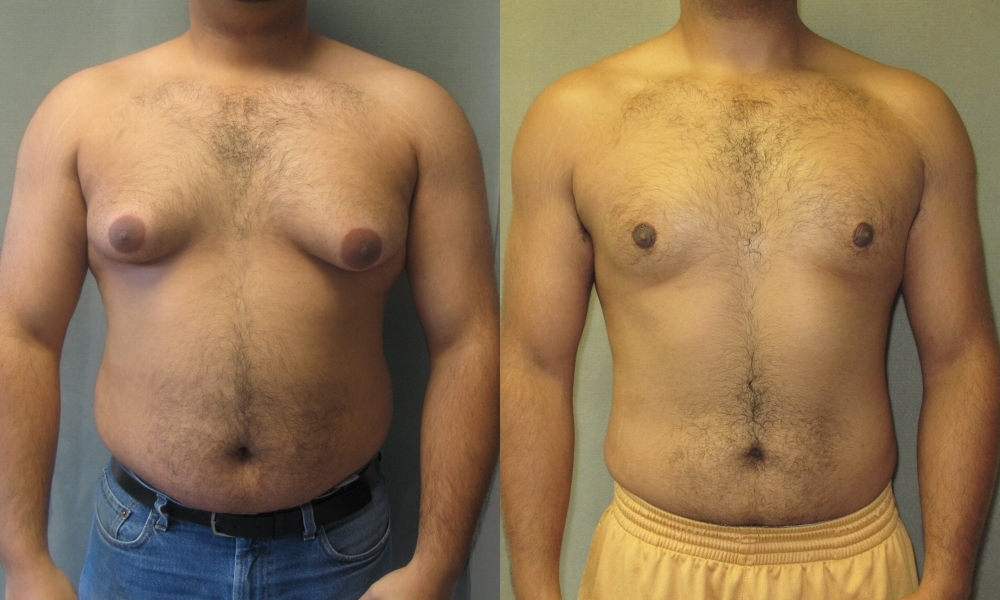 Missing Out Because of Man Boobs? Gynecomastia and Its Cure